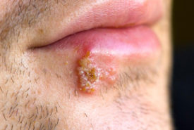 3 quick ways to deal with herpes