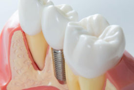 4 practical tips to maintain dental implants for seniors