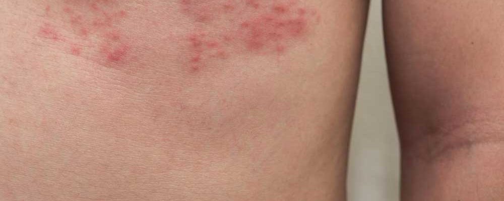 5 Ways to Deal with Shingles Nerve Pain