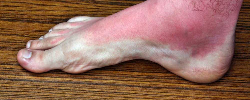 7 Common Causes of Itchy Rashes on Legs