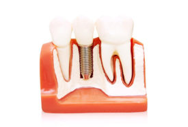 All you need to know about permanent dentures