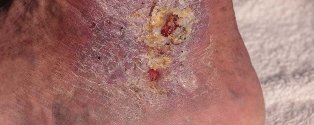 Causes and Symptoms of Cellulitis