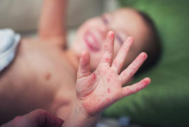 Causes and symptoms of Hand-foot-and-mouth disease