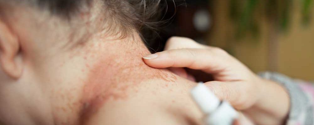 Common Signs and Symptoms of Eczema