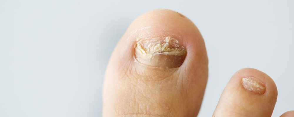 Common nail infections to avoid