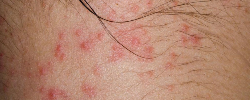 Curious about atopic dermatitis? Here’s what you need to know