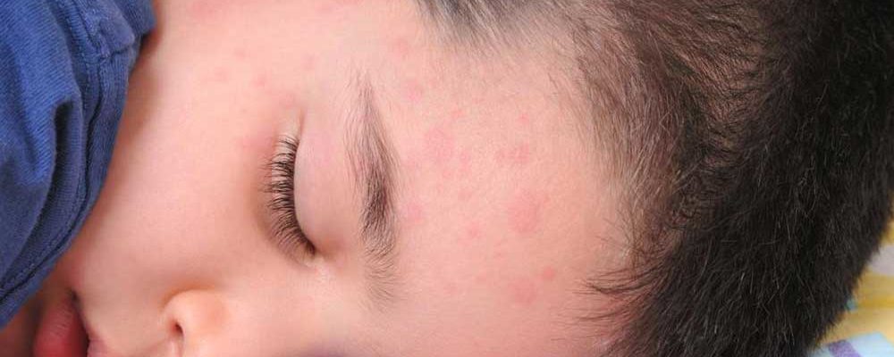Different Types of Skin Rashes