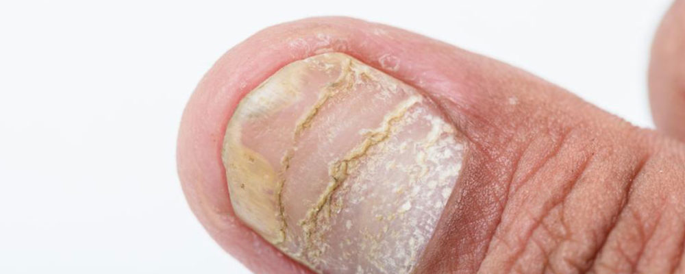 Different types of nail diseases and their causes