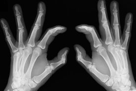 Early signs of rheumatoid arthritis and how to catch them
