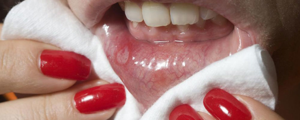 Effective ways to prevent cold sores