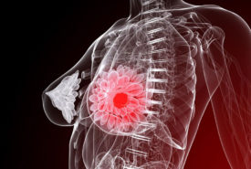 Five things you need to know about breast cancer