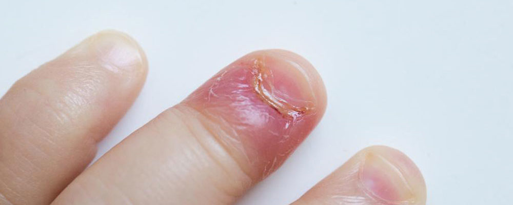 Four reasons for swollen finger pain