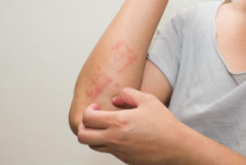 Here’s all that you need to know about scabies skin rash