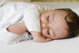 Here’s how to treat skin rashes in babies