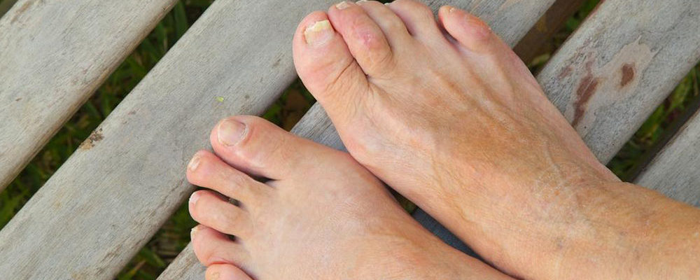 Home remedies for curing toenail fungus