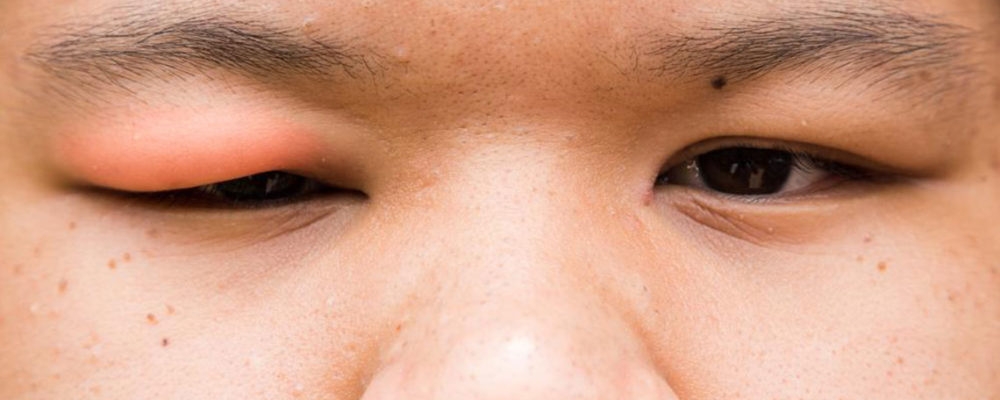 Home remedies to cure everyday eye infections