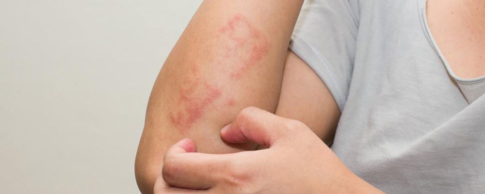 How to identify and treat poison ivy rash with daily use products