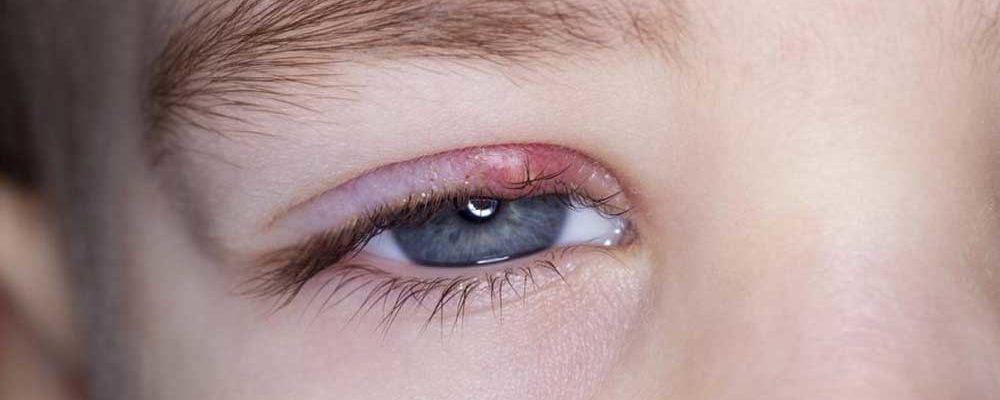 Know about the Symptoms and Causes of Eyelid Inflammation