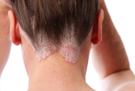 Know the skin ailment: Scalp psoriasis