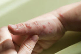 Nerves could be at risk due to shingles