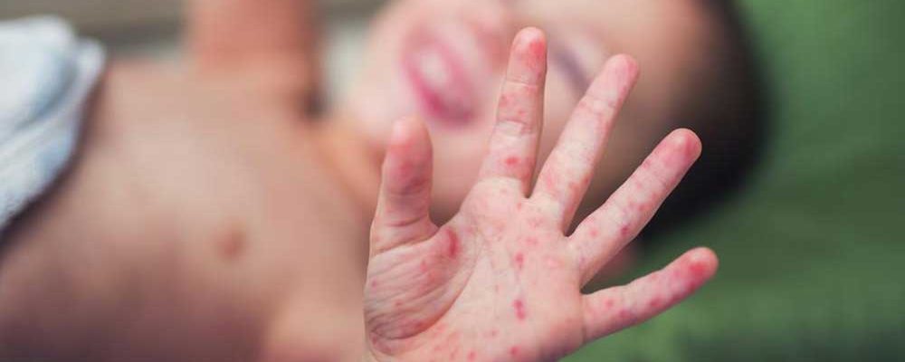 Prevention Tips for Hand, Foot, and Mouth Disease