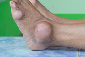 Preventive care for dealing with gout foot pain