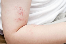 Prevent yourself from shingles before it infects you
