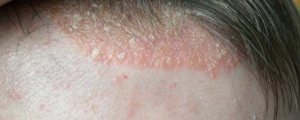Scalp Psoriasis – Symptoms to Watch out For
