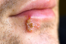 Signs that tell you might have herpes