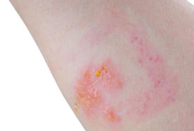 Skin Rash: Which condition is it?