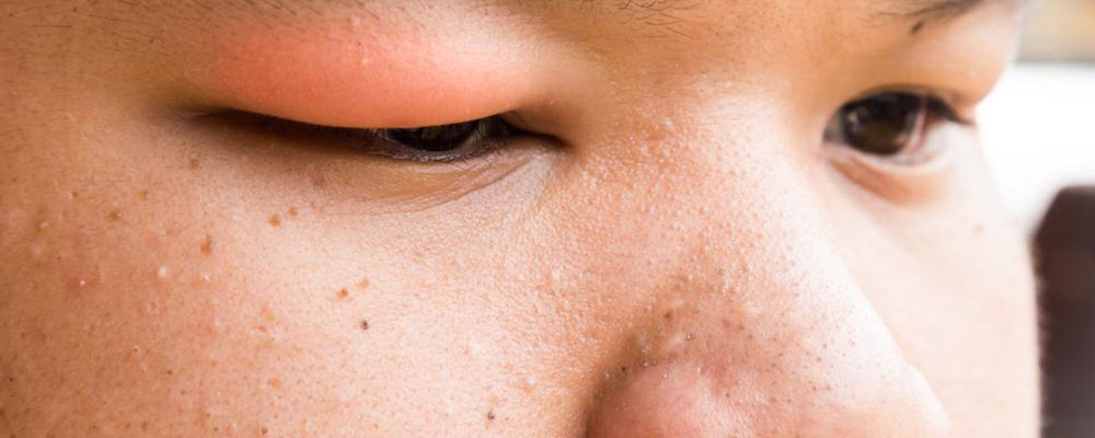 These are the causes of stye that you need to be aware of
