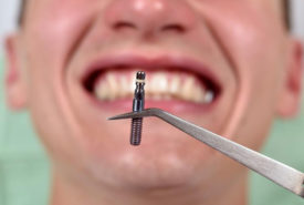 Things you should know about dental implants costs
