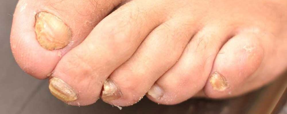 Tips to Treat Nail Fungus Effectively