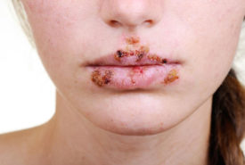 Tips to manage herpes outbreak