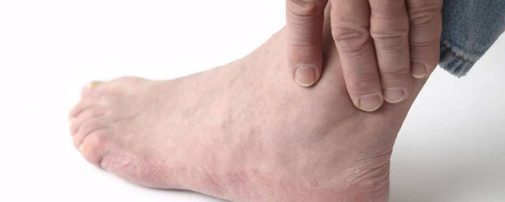 Top Causes of Swollen Ankles