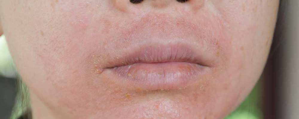Treatment Methods for Lupus Skin Rashes