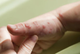 Treatment for symptoms of viral infections