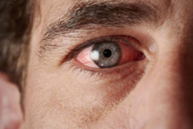 Understanding the causes of chronic dry eye