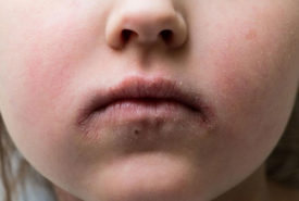Understanding the causes of impetigo in children and adults