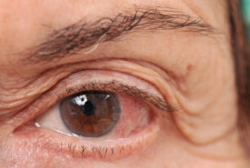 Ways of dealing with chronic dry eye disease