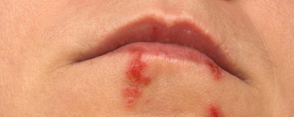 Ways to stop herpes from spreading