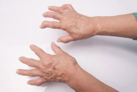 What you need to know about Rheumatoid Arthritis and Lupus