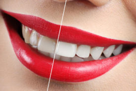 Yellow Teeth – How to avoid discoloration of teeth