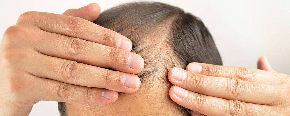 Hair loss – Its symptoms and causes